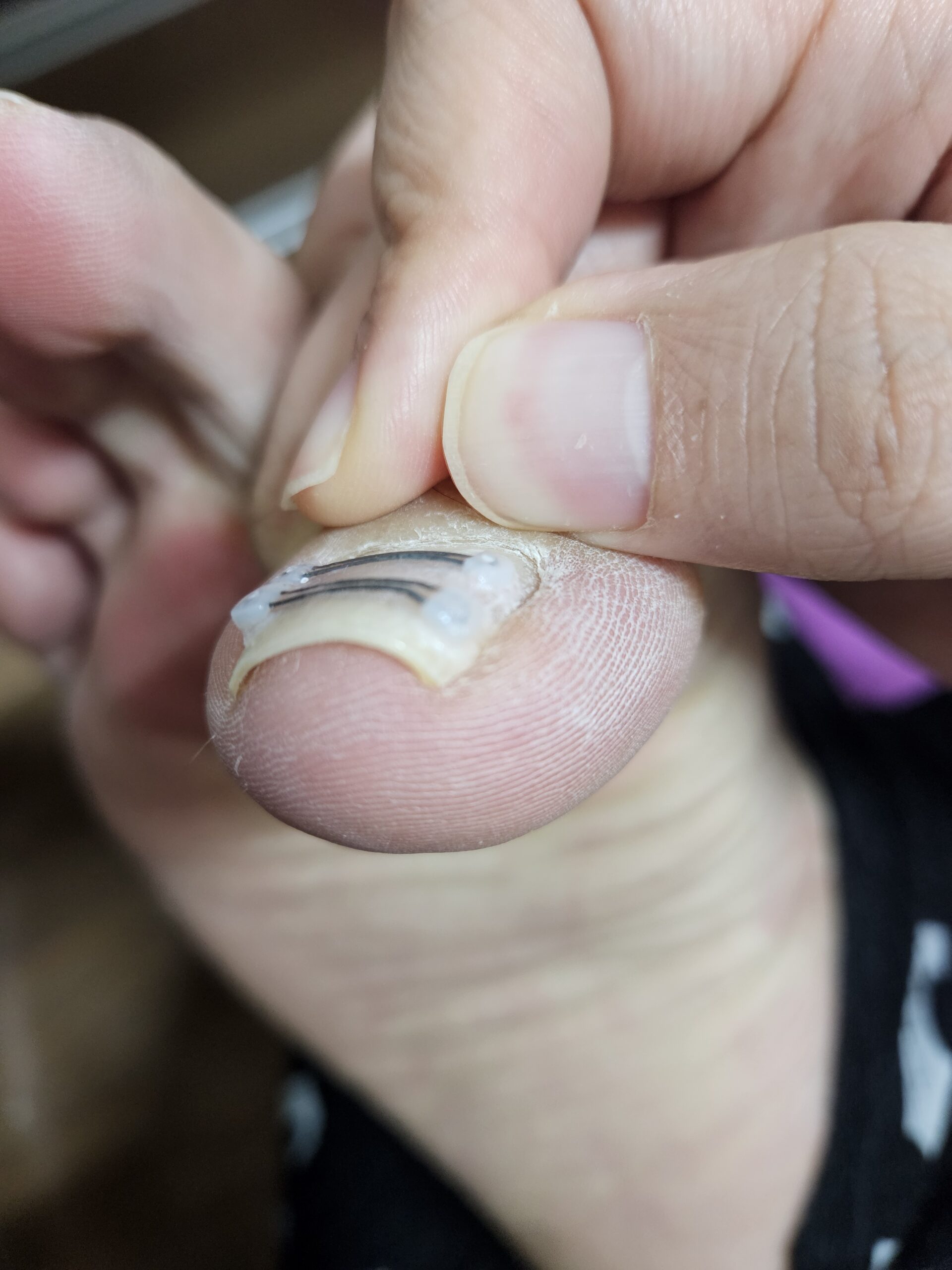 Complete Guide to Ingrown Toenails: Causes, Symptoms, Prevention, and Home Treatment